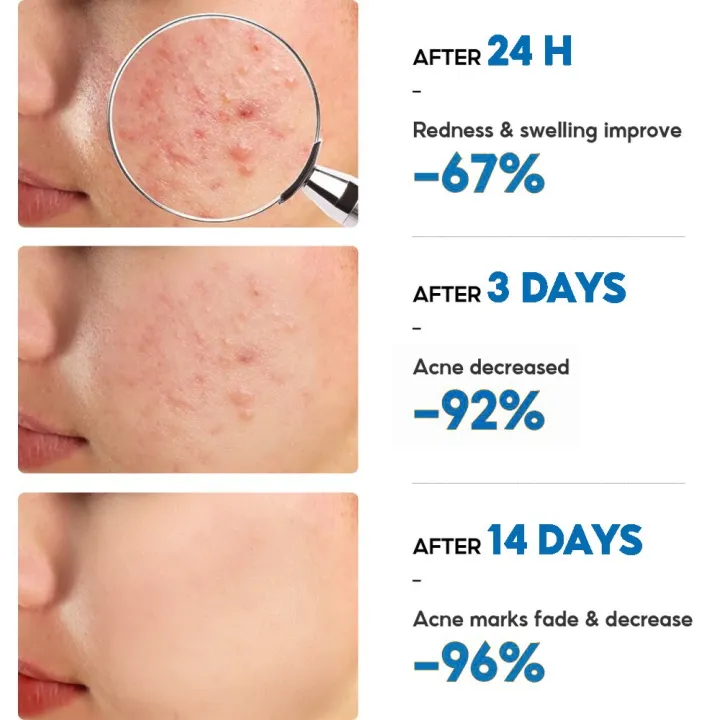 Crema facial para eliminar cicatrices de acné, tratamiento de belleza Aichun, crema antiacné para el cuidado de la piel, crema para los poros