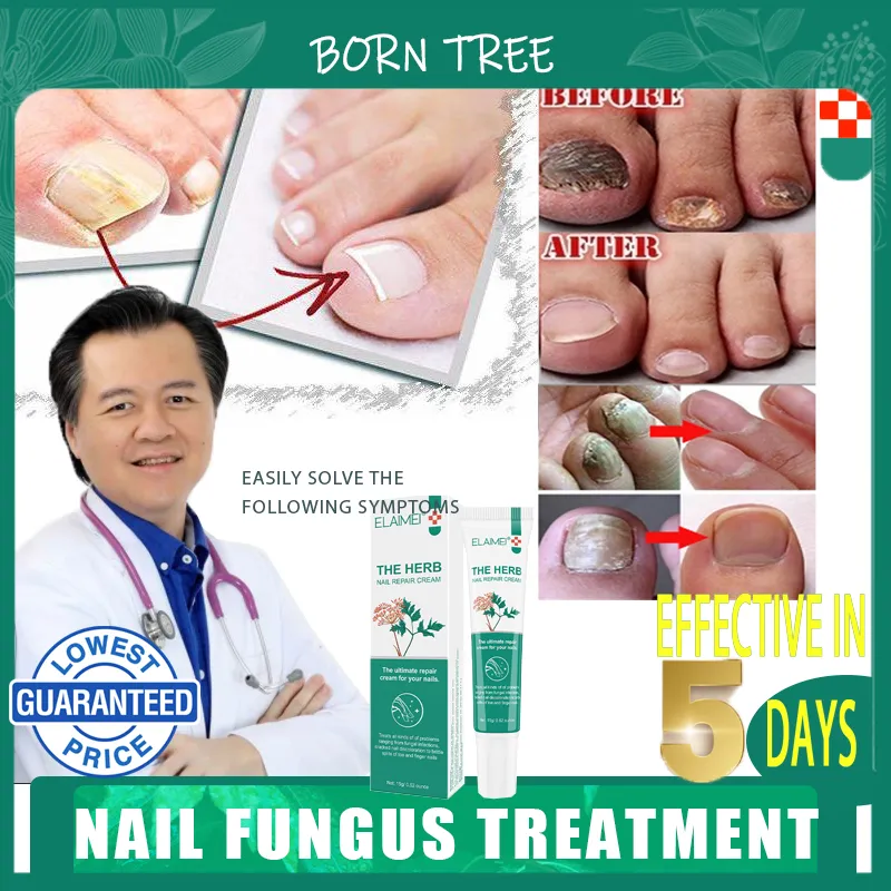 Fungal Nail treatments
