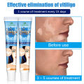 1 hari sembuh KADAI Salep Vitiligo 100% menghilangkan Menghambat Pertumbuhan Kulit Putih mengaktifkan melanin Meratakan Warna Kulit Untuk tubuh dan wajah formula jamu Tidak melukai kulit(vitiligo cream obat salep vitiligo vitiligo obat). 