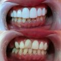 Veneer Gigi 1 Set Lengkap Praktis Original. 
