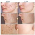 Hot deals Salicylic Acid Daily Gentle Facial Cleanser Removes Acne Whitens and Removes Blackheads By Exfoliating and Keeping Pores Clean to Restore Asid Salicylic Pembersih Muka Lembut Harian  水杨酸每日温和洁面乳通过去角质和保持毛孔清洁来去除痤疮美白和黑头. 