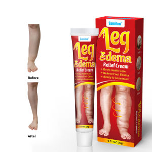 krim bengkak 20g leg edema cream ubat surut bengkak kaki membantu melancarkan darah kurangkan bengkak dan kesakitan 消肿膏