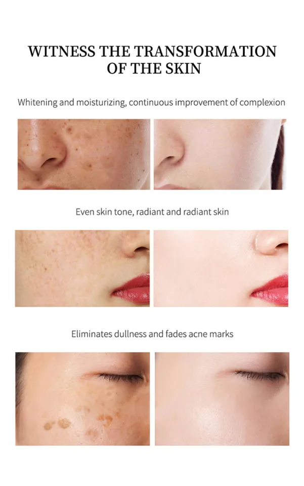 existing goods Genuine YouBuy Remover Effective Melasma Cream