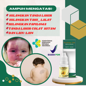 Obat Oles dan Konsumsi Obat Herbal Penghilang Pembersih Tanda Lahir Merah Tanda Lahir Berwarna Coklat Obat Menghilangkan Tanda Lahir di Wajah di Seluruh Badan Tanda Lahir Berwarna Putih Merah Muda Coklat Hitam | Herbal Alami 100% Original