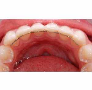 Dây Chỉnh Nha Mặt Lưỡi - Dây Duy Trì Sau Chỉnh Nha ( Gói 2 Dây )