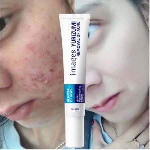 YURIZUMI Obat Jerawat Paling Ampuh Cewek / Acne Removal Cream Acne Treatment Spots Oil Control 20 GR