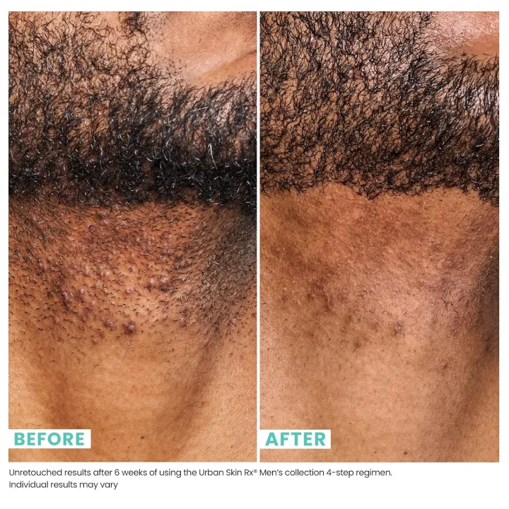 Daily%20Mens%20Exfoliating%20Face%20Wash%20%20%20Scrub%20%7C%20Urban%20Skin%20Rx%C2%AE%20%7C%20Powerful%202-in-1%20Cleanser%20and%20Scrub%20%7C%20Cleans%20Pores%20of%20Dirt%20and%20Oil.%20Formulated%20with%20Salicylic%20Acid,%20Jojoba%20Beads%20and%20Niacinamide%20%7C%205.1%20fl%20oz%20-%20Image%205