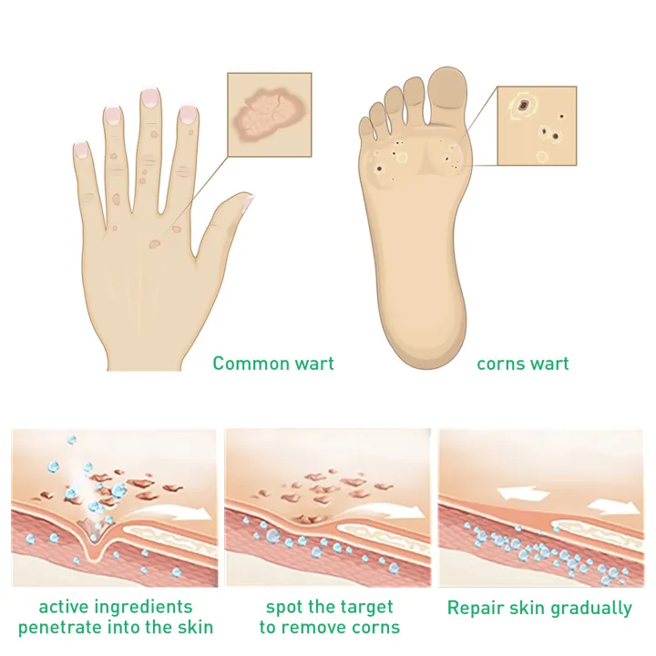 Jaysuing%20Warts%20Remove%20Liquid%20Smooth%20Skin%20Gentle%20Foot%20Care%20Ready%20Stock%20Wholesale%20-%20Image%207