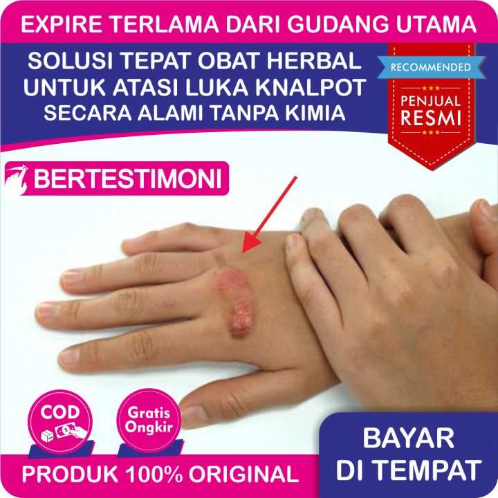 Obat Penghilang Bekas Luka Knalpot Lama, Obat Luka Kena Knalpot Di Apotik, Obat Luka Knalpot Bernanah, Obat Penghilang Luka Bakar Knalpot, Obat Luka Bakar Knalpot Yang Sudah Melepuh, Obat Herbal Propolis SM Brazil 100% Asli Alami Best Seller