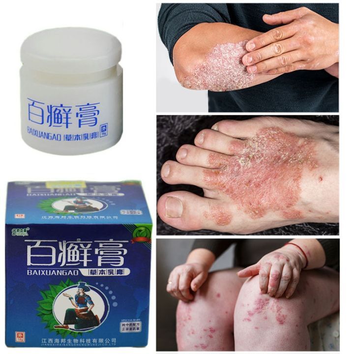 BaiXuanGao Salep Gatal Kulit Jamur Ampuh 3 Seconds To Relieve Itching ...