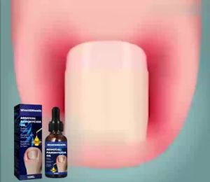 Dầu loại bỏ móng chân mọc ngược mọc ngược phục hồi móng làm mềm móng sửa bị dày