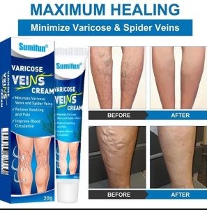 Original Varicose Veins Effective Remover Varicose Vein Remover Cream Ugat Remover Cream