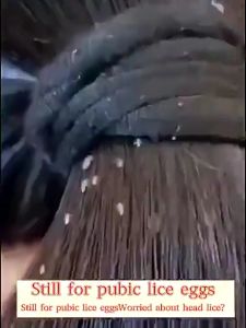 PrettyFloral~lice remover shampoo Licealiz Head Lice Shampoo for kids lice removal treatment shampoo