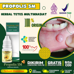 Obat Mukokel Obat Benjolan Di Bibir Mulut Lidah Gusi Bengkak Kista Mukokel Penghilang Benjolan di Bawah Lidah Propolis SM Asli 100% Original