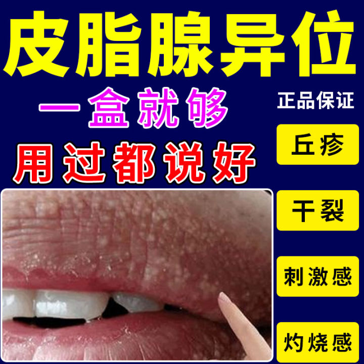 Sebaceous Gland Ectopic Disease Dry Mouth And Lips Cracking Peeling