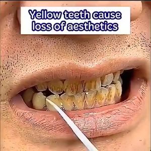 ubat gigi pemutih bodyaid Mint whitening toothpaste pemutih gigi kuning teeth whitening Gigi Putih Fresh Breath