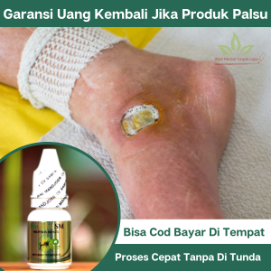 Obat Pengering Luka Diabetes Obat Tetes Luka Diabetes Basah Obat Luka Diabetes Bernanah Obat Penghilang Luka Borok bernanah di kaki Obat Diabetes Penurun Gula Darah Obat Oles Luka Diabetes Agar Cepat Kering Obat Penyakit Gula Dengan Propolis Sm