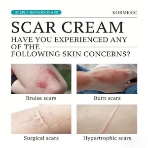 Japanese Formula Scar Remover for Old Scar On Leg Remove Stretch Mark Remover Acne Scar Remover COD