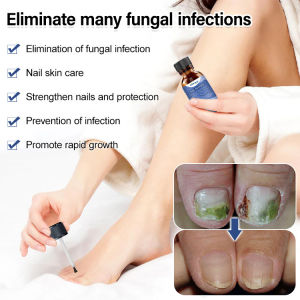 Bee Venom Nail Treatment Solution Nail Root Care/Nutrition Treatment/Hand Foot Nail Repair/Home Care For Adults/Damaged Nails