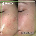 Kem Dưỡng Dermacos Anti-Acne Matting Cream 50Ml - Giảm nhờn, ngừa mụn. 