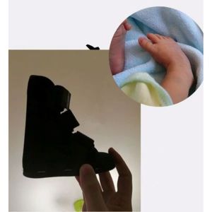 Childrens T-shaped wooden board shoes anti rotation shoes ankle joint fixation splint foot support postoperative rehabilitation shoes