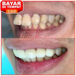 Alat perapih gigi tidak rata Alat perapih gigi tonggos atas dewasa anak Alat perapih gigi berantakan original Alat untuk merapihkan gigi tonggos Alat untuk merapihkan gigi berantakan Alat merapihkan gigi tanpa behel Alat untuk merapihkan gigi renggang [Ta