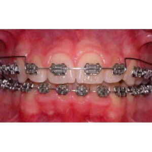 Dây Đánh Lún Nhóm Răng Cửa Nhiều Size Hàm Trên & Hàm Dưới