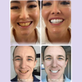 Gentle Teeth Stain Remover And Whitening Powder Brightening Teeth Powder Remove Tooth Stains And Yellowing Tooth Cleaning Powder. 