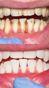 BUY 1 TAKE 1 ALIVER Teeth Whitening Mousse Toothpaste Remove Plaque Oral Odor Cleansing Teeth