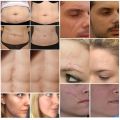 Japan Penghilang Bekas Luka Scar Cream Removal Krim Penghilang scar keloid bopeng bekas luka lama dan baru Old Scar Remover Gel Repairs Whole Body Scars Stretch Marks Pockmarks and Acne Marks 30g. 