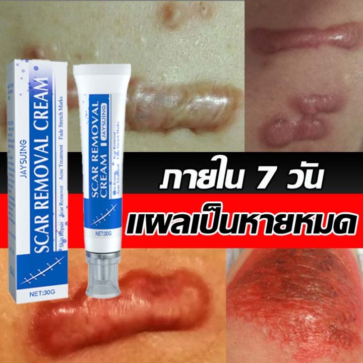 ลบรอยแผลเป็นสีดำ ออกแบบมาเพื่อฟื้นฟูแผลเป็นโดยเฉพาะ ซึมซาบลึกสู่ผิว ลด ...