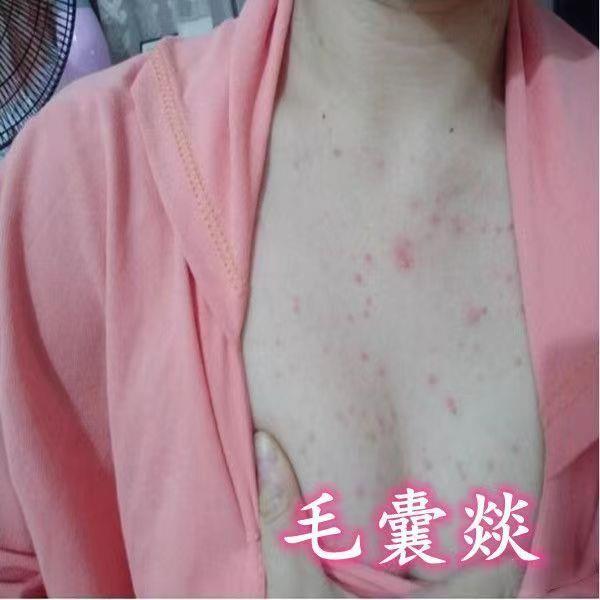 Chest Long Blain Blain On The Chest Bumps Fungal Infection Redness