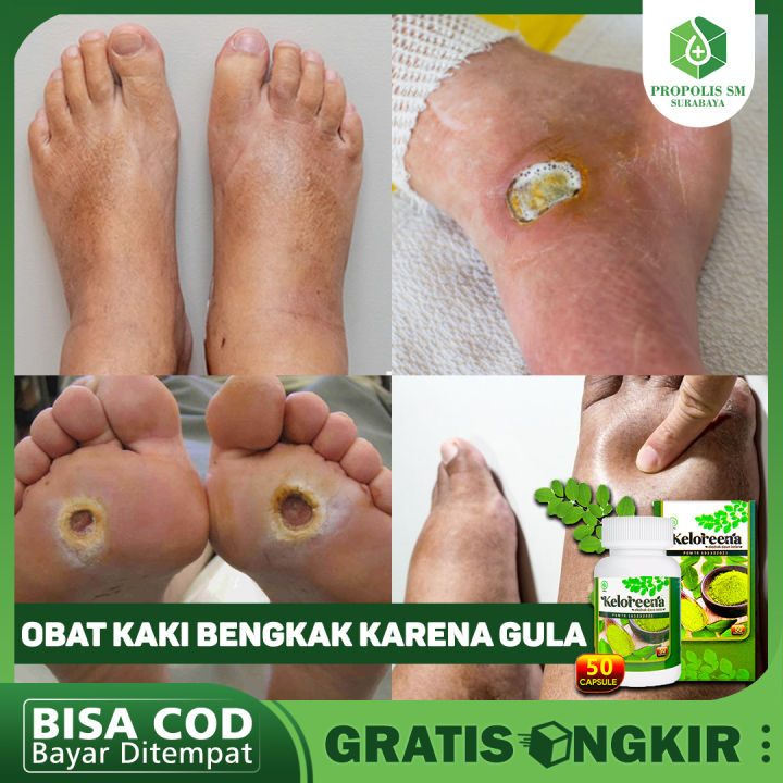 Gambar Kaki Bengkak Karena Diabetes