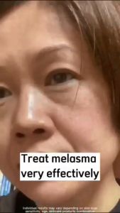 JAPANESE MELASMA PEKAS Remover Yunnan Herbal Cream White Spot Cream Sunburn Anti-Spot Cream 20g