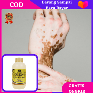 Obat Vitiligo Kulit Belang Bercak Putih Panu Kadas Kurap Exsim Gatal Kanker Kulit Original Bisa COD