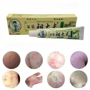 Zudaifu Skin Herbal Psoriasis Dermatitis Eczema Pruritus Cream Ointment tanggal kati kati