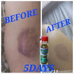 Ayurvedic 15ml x 2pcs Treatment Oil For Wounds And Skin Problem / Minyak Luka Dan Masalah kulit / காயங்கள் மற்றும் தோல் பிரச்சனை 100% Cure Readystock