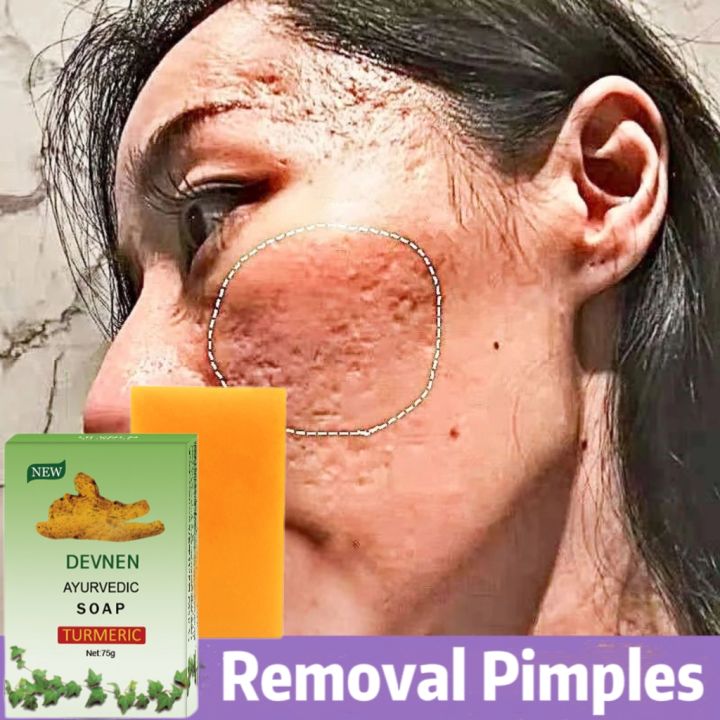 glutathione soap breakout Glupa Papaya Whitening - Acne-Free Skin Solutions Gluta Master Glutathione Acne Pimples