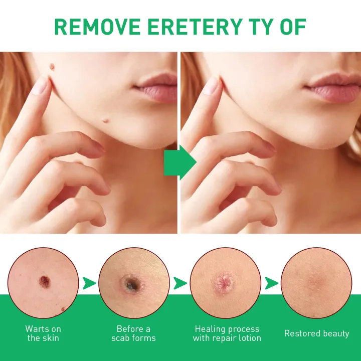 Jaysuing%20Warts%20Remove%20Liquid%20Smooth%20Skin%20Gentle%20Foot%20Care%20Ready%20Stock%20Wholesale%20-%20Image%204