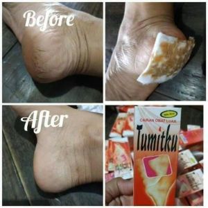 𝗕𝗣𝗢𝗠 TUMITKU Obat Kaki Pecah 100% Original Solusi Kaki Kalus Pecah Kapalan Kering
