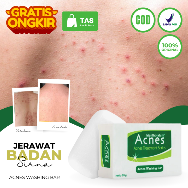 Obat Jerawat Yang Ampuh - Sabun Jerawat Badan Punggung Paling Ampuh Sabun Mandi Untuk Mengatasi Jerawat Dan Penghilang Bekas Jerawat