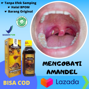 Obat Radang Amandel Obat Herbal Sirup Mengecilkan Amandel Nyeri Pembengkakan Amandel Bernanah Madu Amandel Akut Penghancur Amandel Dewasa Sakit Tenggorokan Panas Rasa Terbakar Perih Terasa Mengganjal Gurah Suara Serak Batuk - Kurmaqu 100% Alami