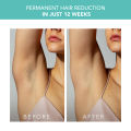 FOREO PEACH 2 IPL Hair Removal Device - Easy Permanent Hair Removal | Laser Hair Removal For Body & Face | Fast | Painless Hair Removal | Skin Cooling. 