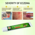 SUMIFUN ECZEMA CREAM HERBAL ANTI BACTERIAL CREAM PSORIASIS DERMATITIS ...