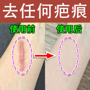 💗🙋‍♀️💗祛淡疤膏除淡疤膏修复无痕烫伤膏淡化增生剖腹产修复美容院疤痕膏