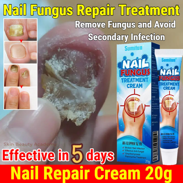 2 Pack Nail Repair Gel Pen - Toenail Fungus Treatment - Antifungal Nail  Treatment - Walmart.com