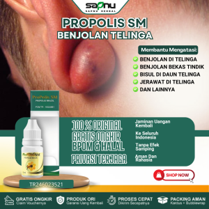 Obat Benjolan Telinga Obat Penghilang Keloid Di Telinga Obat Benjolan Bekas Luka Tindik Obat Benjolan di Daun Telinga Obat Benjolan Keras Di Telinga Obat Benjolan dibelakang Telinga Obat Telinga Bengkak Dengan Propolis SM
