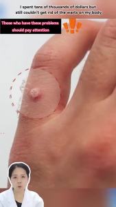 【Ship in 24H】【Buy 2 get 1 free】Krem warts Japan develops wart removing cream 克疣膏