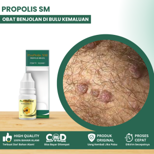 Obat Benjolan Di bulu Kemaluan Obat Gatal Jamur Kulit Di Bulu Kemaluan Obat Pengempes Benjolan Kelamin Pria & Wanita Obat Gatal Di Area Kemaluan Obat Penghilang Benjolan Kelamin Obat KUtil Kelamin Dengan Propolis SM