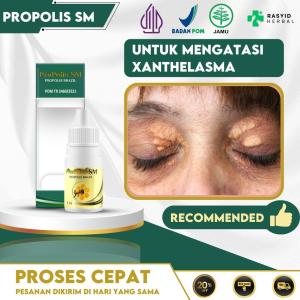 Obat Xanthelasma Gumpalan Lemak Di Area Mata Penghilang Milia Dekat Mata Demgan Propolis SM